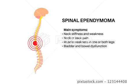 Spinal ependymoma cancer Spinal ependymoma cancer 123144408