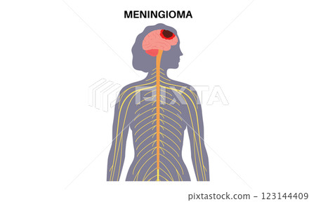 Meningioma cancer concept 123144409
