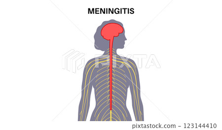 Meningitis medical poster Meningitis medical poster 123144410