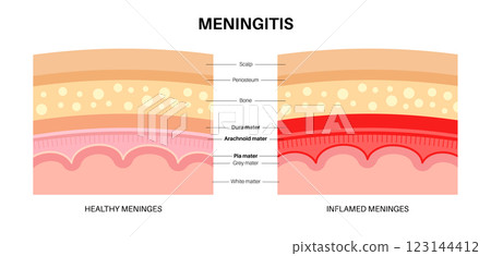 Meningitis medical poster Meningitis medical poster 123144412