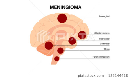 Meningiomas cancer poster Meningiomas cancer poster 123144418