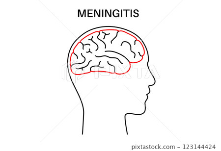 Meningitis medical poster 123144424