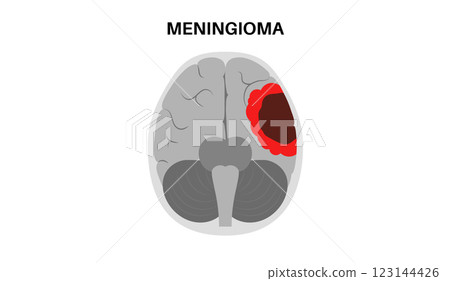 Meningioma cancer concept 123144426