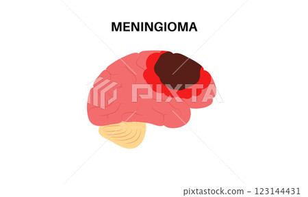 Meningioma cancer concept 123144431