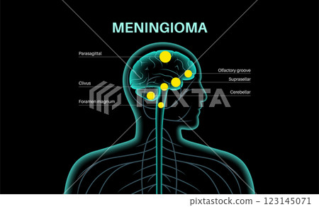 Meningiomas cancer poster 123145071