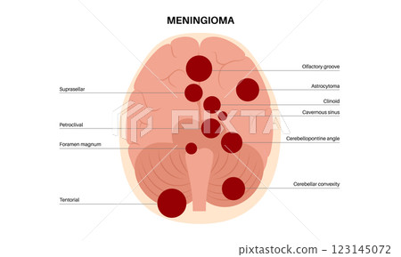 Meningiomas cancer poster 123145072