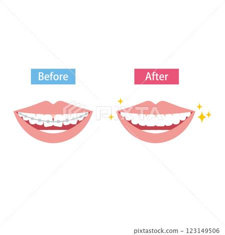 鋼絲矯正牙齒矯正前後比較圖 鋼絲矯正牙齒矯正前後比較圖 123149506