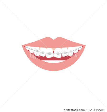 Illustration of teeth alignment after wire correction 123149508