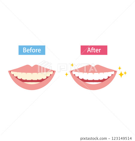 牙齒美白前後對比圖 123149514