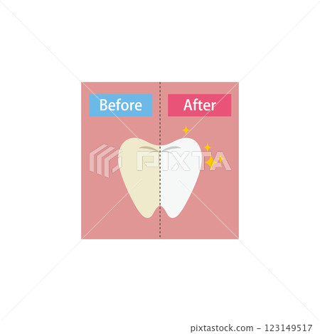 牙齒美白前後對比圖 123149517