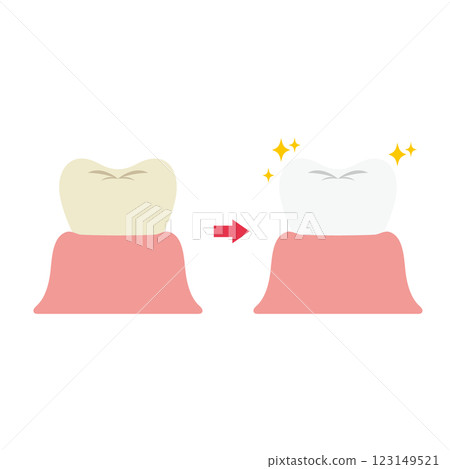 牙齒美白前後對比圖 123149521