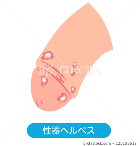 Genital herpes: Bumps on the male genitals Genital herpes: Bumps on the male genitals 123158612