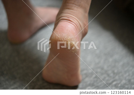 腳跟開裂 123160114