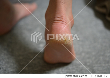 Cracked heels 123160117