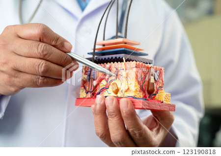 Hair transplant, Asian dermatologist doctor holding skin structure anatomy model for treatment in hospital. 123190818