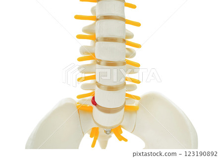 Spinal nerve and bone, Lumbar spine displaced herniated disc fragment, Model for treatment medical in the orthopedic department. 123190892