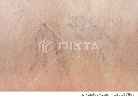Close up of visible varicose veins on human skin showing vascular condition Close up of visible varicose veins on human skin showing vascular condition 123197965