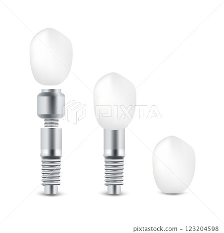 Dental tooth implant infographic 123204598