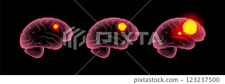 Brain cancer grade 123237500