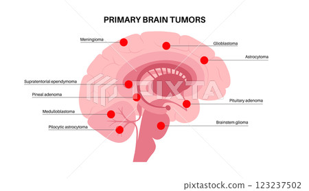 Primary brain tumors Primary brain tumors 123237502