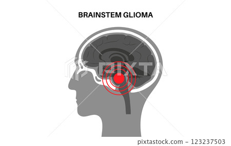 Brainstem glioma cancer 123237503
