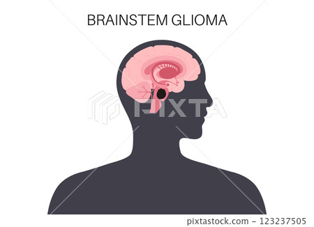 Brainstem glioma cancer Brainstem glioma cancer 123237505