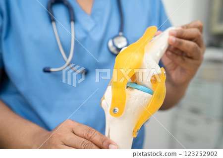 Osteoarthritis of the knee, Doctor holding human knee joint orthopedic anatomy model in hospital. 123252902