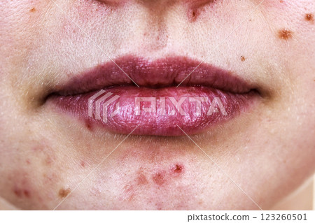 Female face with acne skin problem 123260501