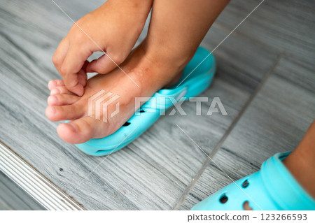 Child scratching foot with redness from mosquito bite, skin irritation. 123266593