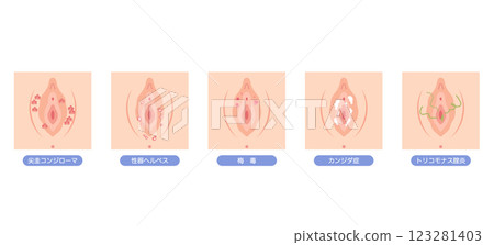 女性外生殖器疾病 123281403