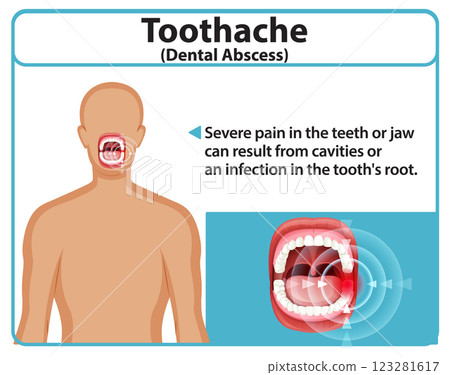 Understanding Toothache and Dental Abscess Understanding Toothache and Dental Abscess 123281617