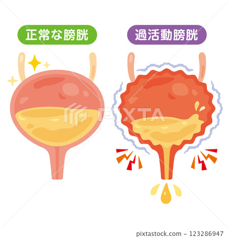 正常膀胱和過度活動性膀胱的圖示 正常膀胱和過度活動性膀胱的圖示 123286947