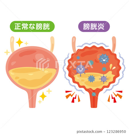 Illustration of a normal bladder and cystitis 123286950
