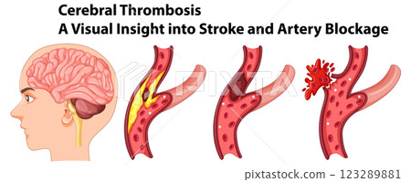 Understanding Cerebral Thrombosis and Stroke Understanding Cerebral Thrombosis and Stroke 123289881