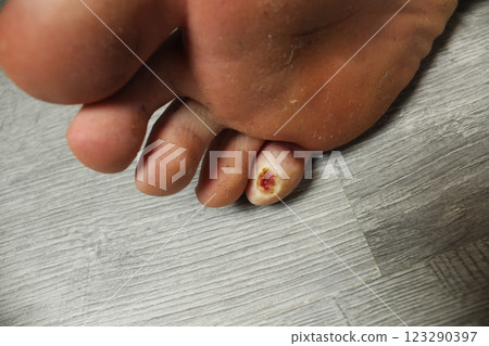Little toe on the foot with a wound. Leg Treatment Little toe on the foot with a wound. Leg Treatment 123290397