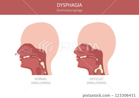Oral dysphagia diseases. Otorhinolaryngology. Difficult swallowing. Medical infographic design Oral dysphagia diseases. Otorhinolaryngology. Difficult swallowing. Medical infographic design 123306431