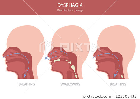 Oral dysphagia diseases. Otorhinolaryngology. Difficult swallowing. Medical infographic design 123306432