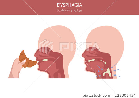 Oral dysphagia diseases. Otorhinolaryngology. Difficult swallowing. Medical infographic design 123306434