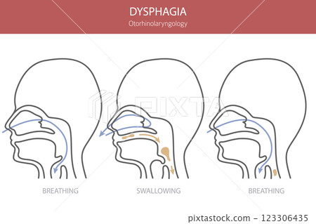Oral dysphagia diseases. Otorhinolaryngology. Difficult swallowing. Medical infographic design 123306435