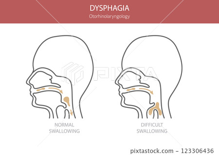 Oral dysphagia diseases. Otorhinolaryngology. Difficult swallowing. Medical infographic design 123306436