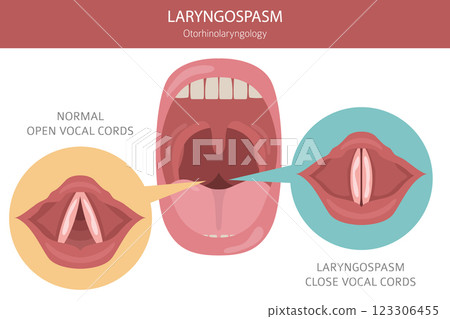 Laryngospasm diseases. Otorhinolaryngology. Vocal cord disfunction. Medical infographic design 123306455