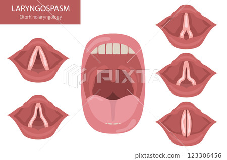 Laryngospasm diseases. Otorhinolaryngology. Vocal cord disfunction. Medical infographic design 123306456