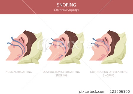 Snoring diseases. Obstructive sleep apnea. Sleep related breathing disorder. Medical infographic design Snoring diseases. Obstructive sleep apnea. Sleep related breathing disorder. Medical infographic design 123306500