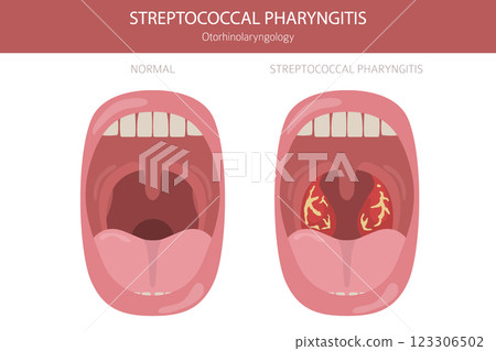Tonsils and throat diseases. Streptococcal Pharyngitis. Medical infographic design 123306502
