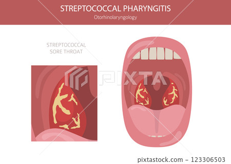 Tonsils and throat diseases. Streptococcal Pharyngitis. Medical infographic design 123306503