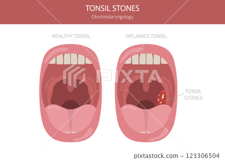 Tonsil stones diseases. Otorhinolaryngology. chronic caseous tonsillitis. Medical infographic design 123306504
