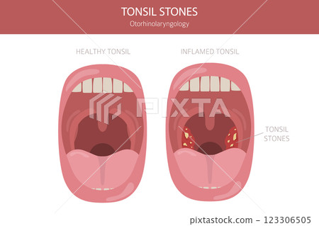 Tonsil stones diseases. Otorhinolaryngology. chronic caseous tonsillitis. Medical infographic design Tonsil stones diseases. Otorhinolaryngology. chronic caseous tonsillitis. Medical infographic design 123306505