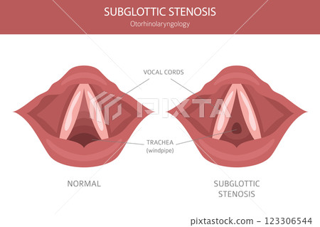 Subglottic Stenosis diseases. Pulmonology, otolaryngology. Medical infographic design 123306544