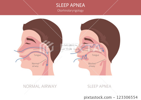 Sleep Apnea diseases. Otorhinolaryngology. Sleep related breathing disorder. Medical infographic design Sleep Apnea diseases. Otorhinolaryngology. Sleep related breathing disorder. Medical infographic design 123306554