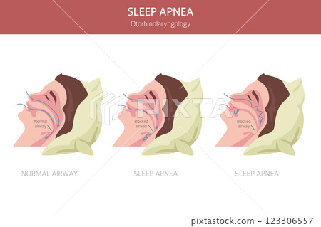Sleep Apnea diseases. Otorhinolaryngology. Sleep related breathing disorder. Medical infographic design 123306557